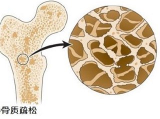 骨密度检测仪告诉你隐性骨质疏松严重超乎你的想象