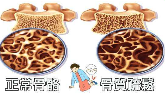骨密度检测仪厂家教您如何理解骨密度评分