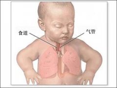 母乳分析仪厂家解释乳汁吸入性肺炎