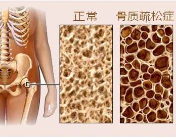 山东国康骨密度仪厂家告诉中老年人如何预防骨质疏松性骨折