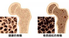 超声骨密度仪检测骨质疏松症，早发现早治疗