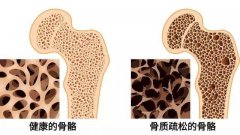 超声骨密度仪检测骨质疏松症，早发现早治疗