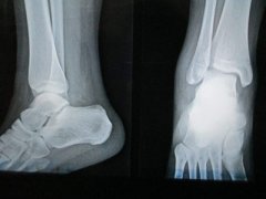 骨密度仪生产厂家讲述骨折怎么恢复快