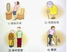骨密度仪生产厂家浅谈骨质疏松有何表现