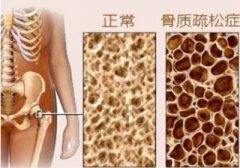 骨密度仪厂家浅谈骨密度下降有信号